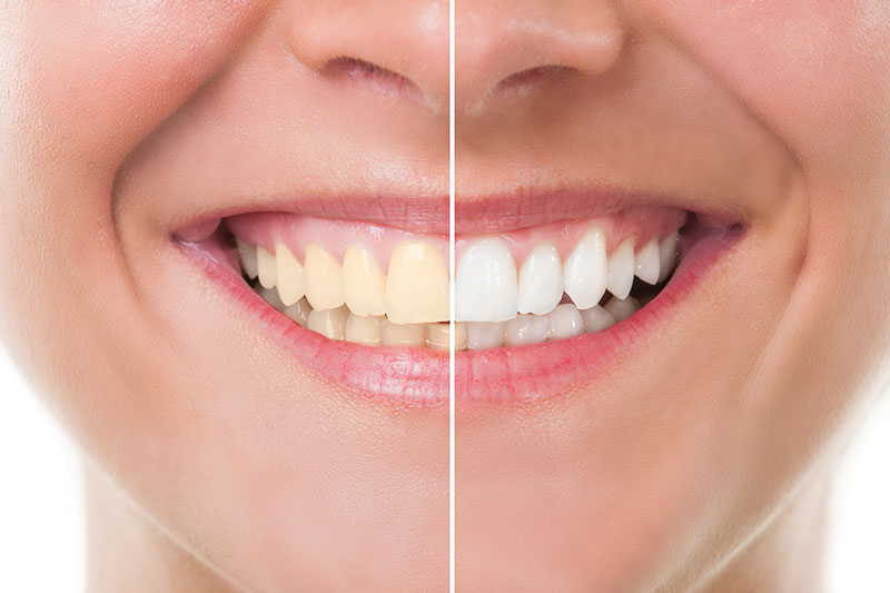 Teeth Whitening in Alexandria